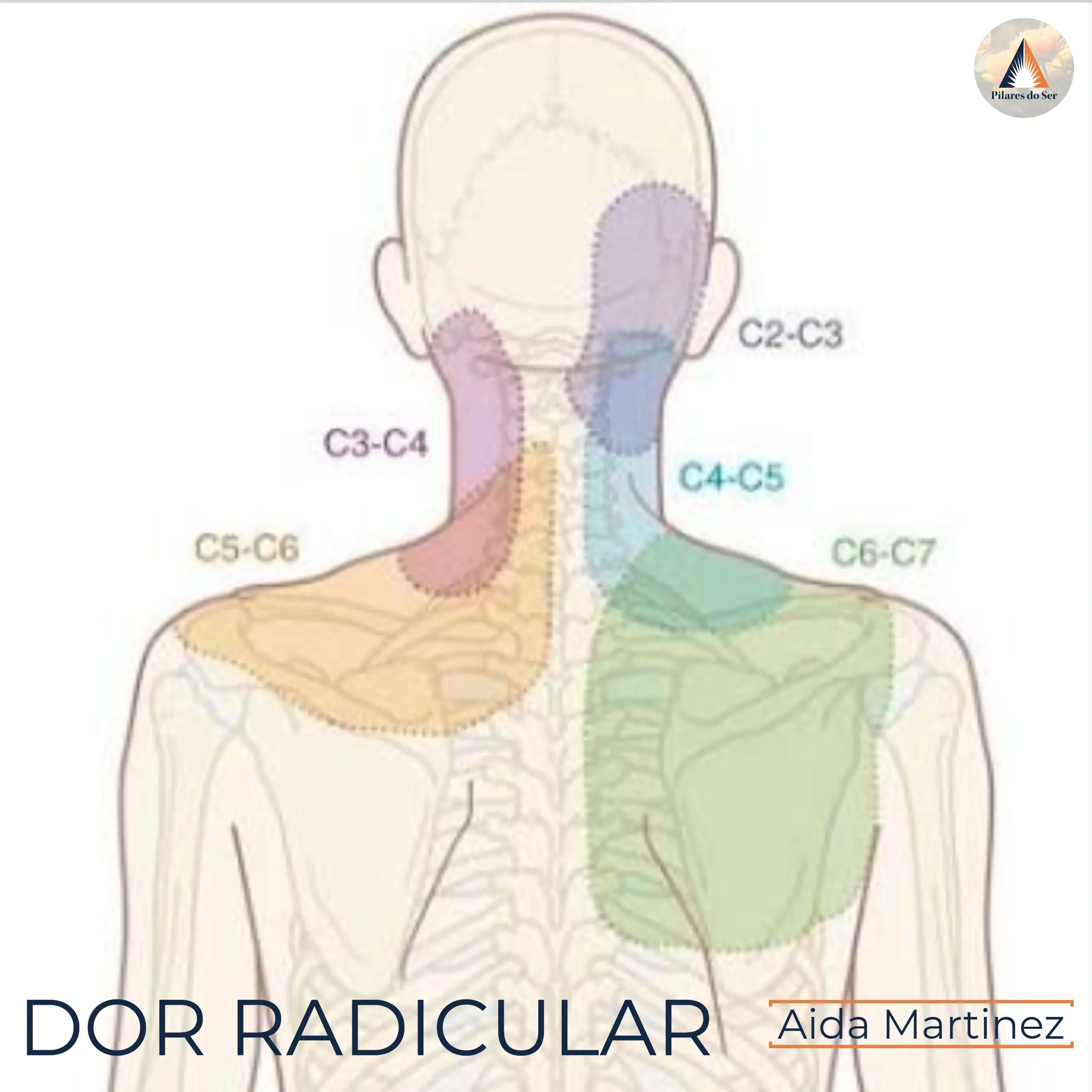 Dor Radicular